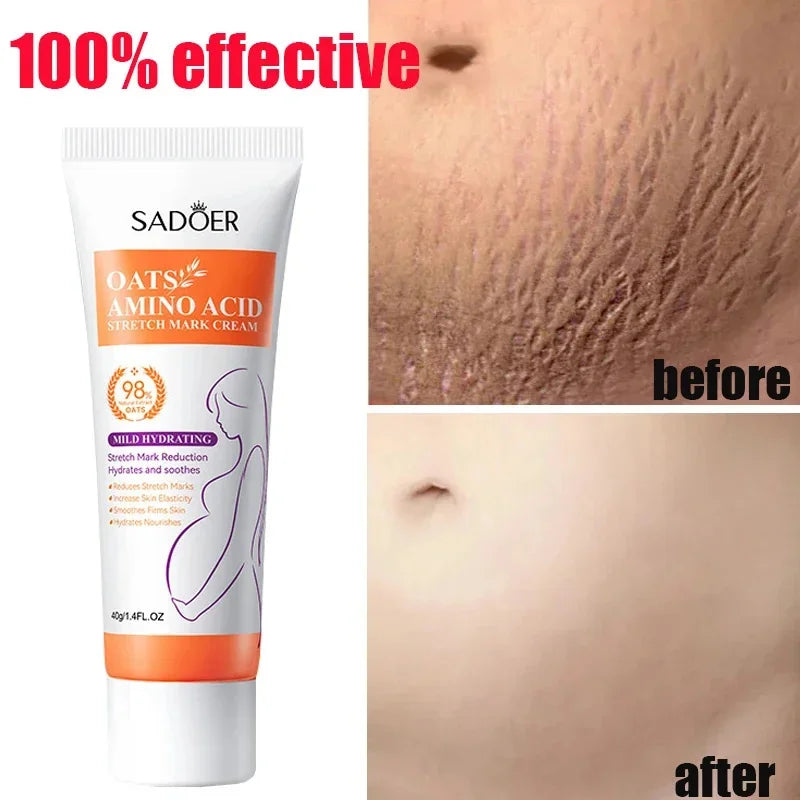 Stretch Marks Permanent Removal Cream Eliminate Body Belly Stretch Marks Swelling Marks Remove Skin Cracks Repair Firming Care