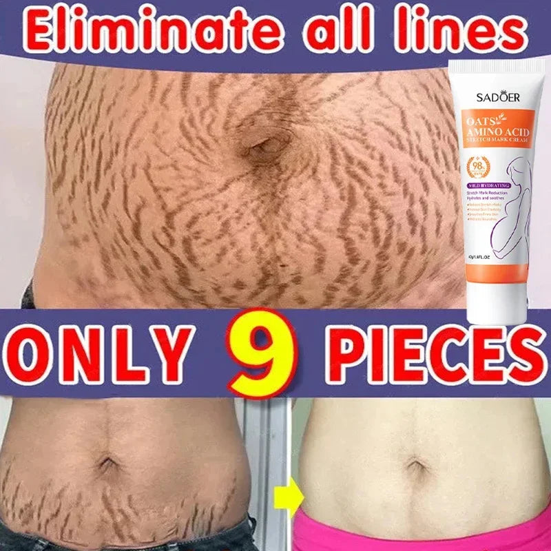 Stretch Marks Permanent Removal Cream Eliminate Body Belly Stretch Marks Swelling Marks Remove Skin Cracks Repair Firming Care